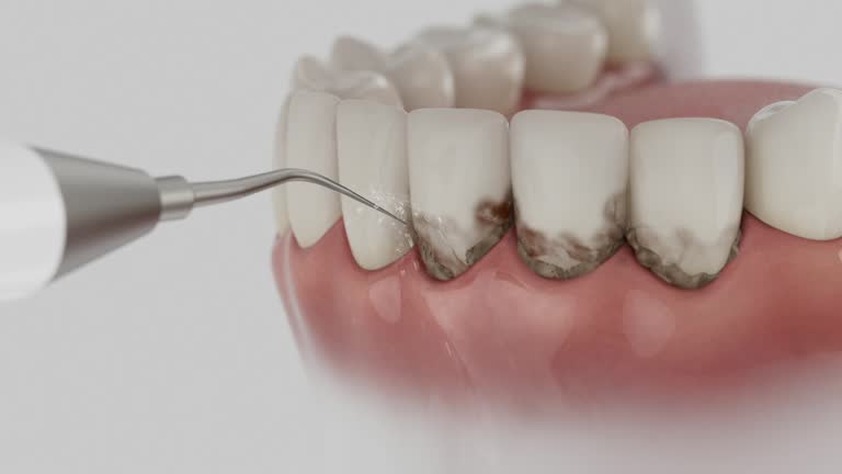 Trusted Wisdom Tooth Removal service in The Colony, TX - Dentist Open Now